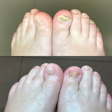 Skúsenosti s používaním promarkového krému Barnabas z Izraela, fotografia pred a po