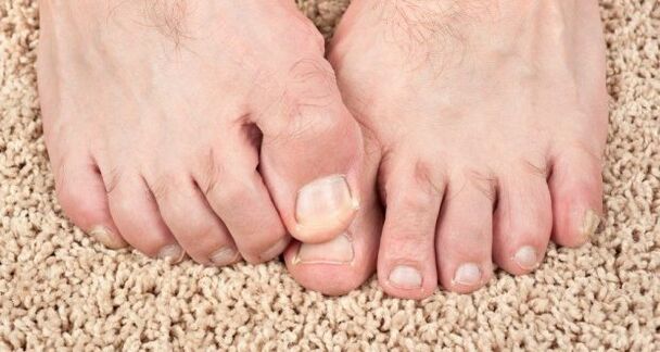 Príznaky húb nechtov