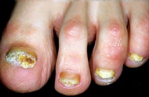 Charakterizácia choroby