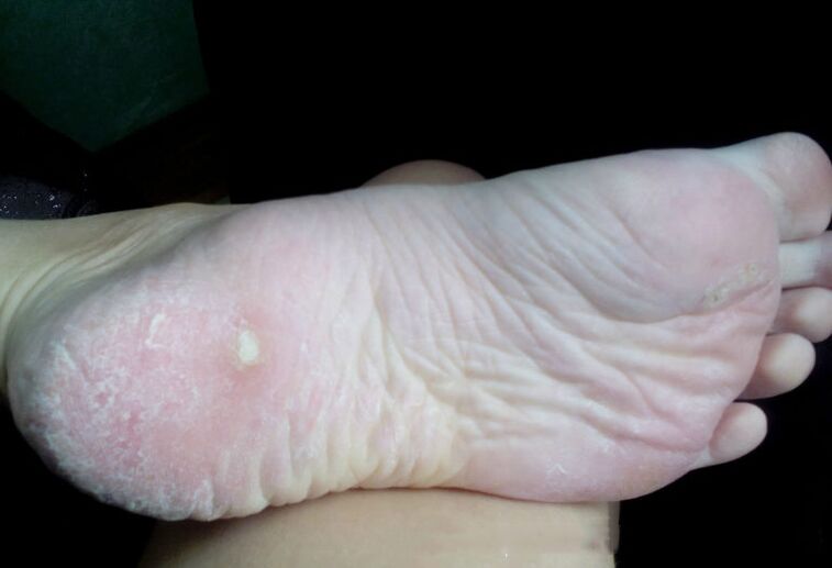 Liečba huby laserom