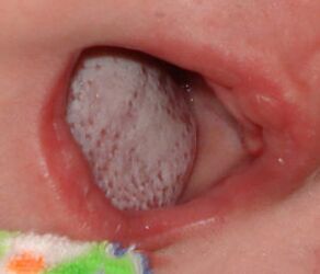 Lokalizácia choroby pomocou huby