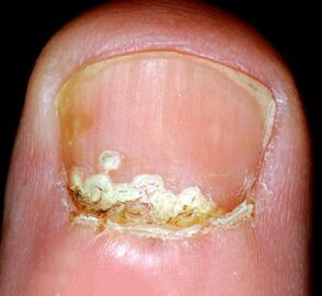 Príznaky a príznaky choroby