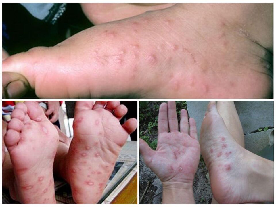 Hyperkeratotické lézie chodidiel