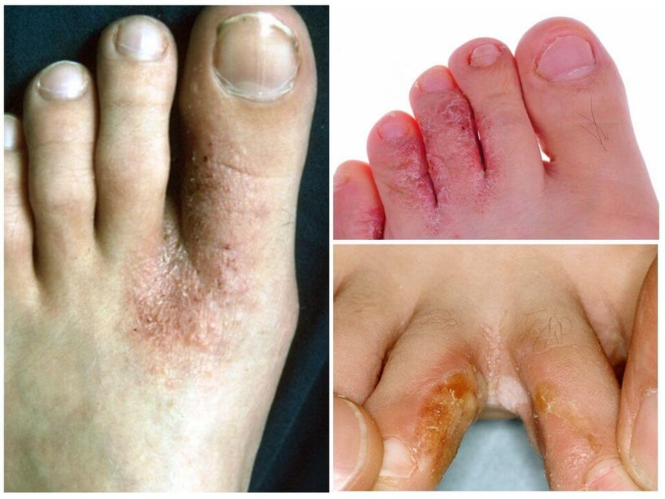 Interdigitálna mykóza
