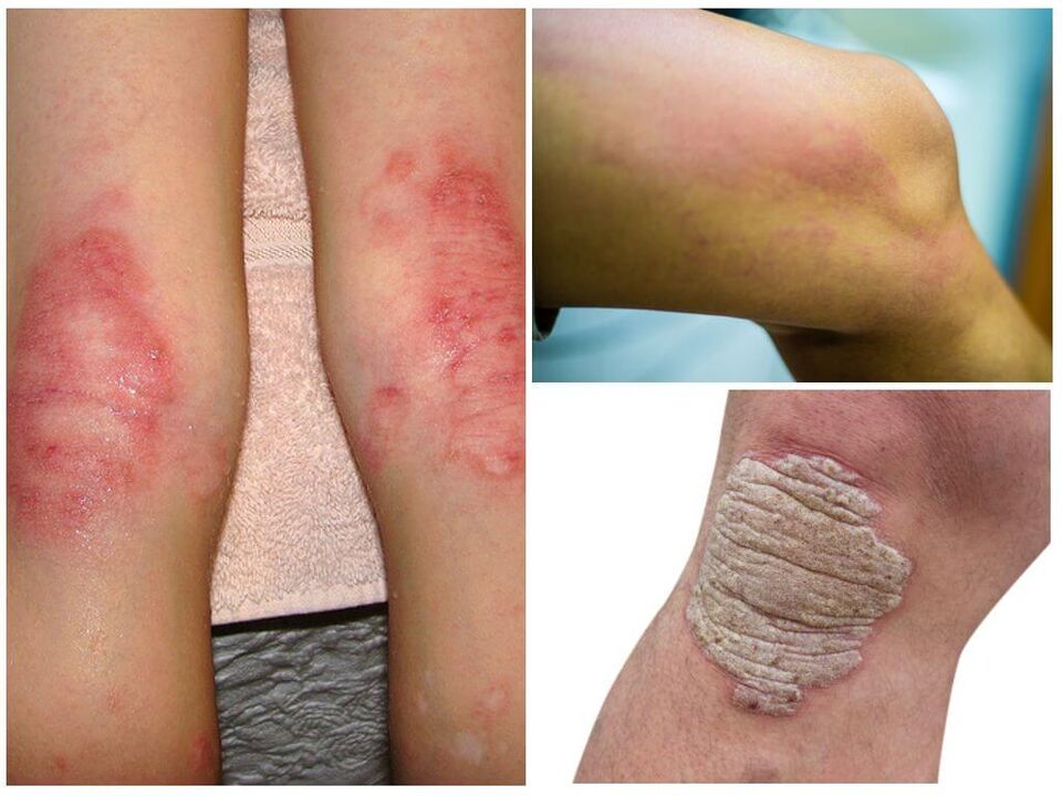 Plesňové infekcie kolien