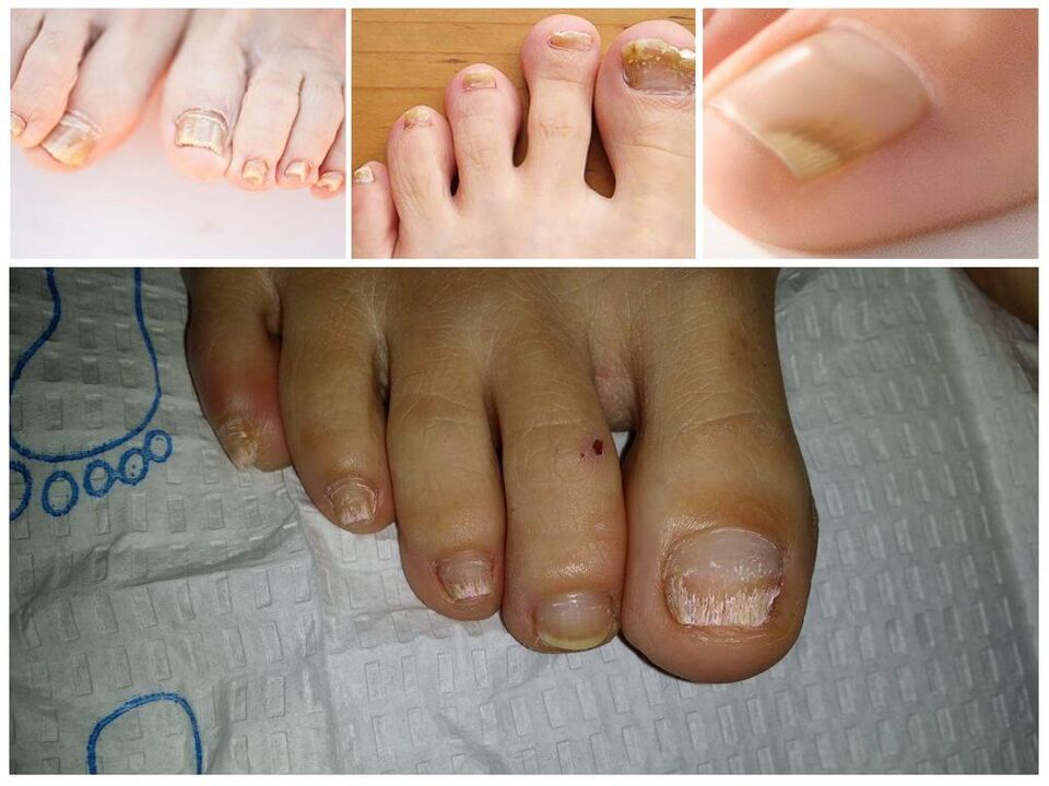 Plesňové ochorenia nechtových platničiek