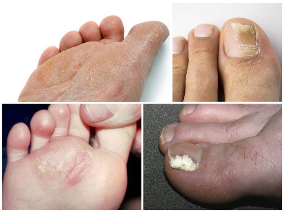 Počiatočná fáza huby na nohách