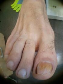 pleseň nechtov na nohách