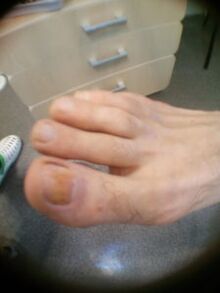 počiatočné štádium plesne nechtov na palci na nohe