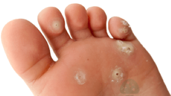 druhá fáza plesňovej infekcie