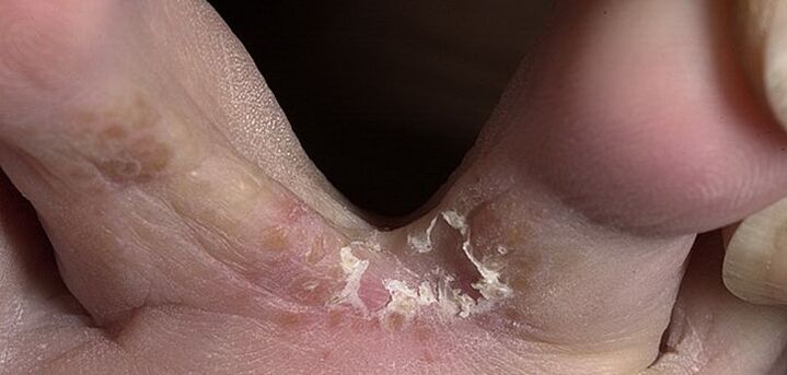 huba medzi prstami na nohách