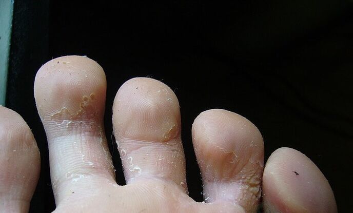 počiatočné štádium huby